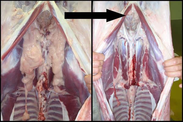 Kidney fat removal